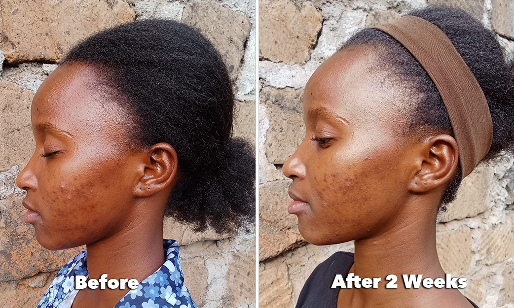 Blemish Control Serum -before and after