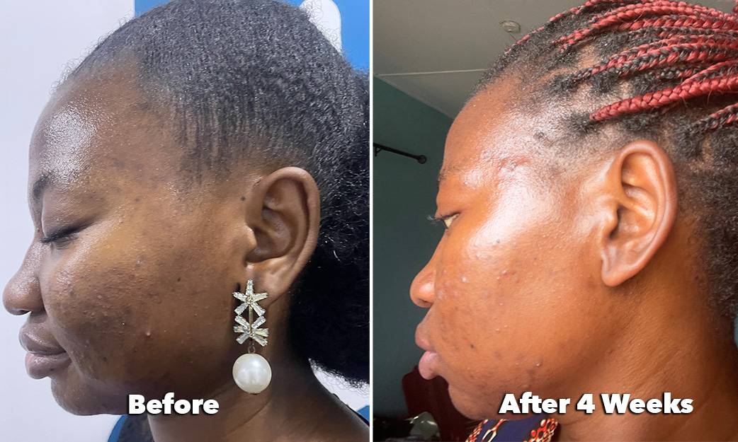 Dark Spot Serum Before and After